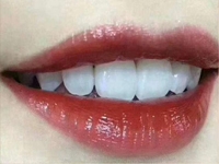 贵阳牙齿美白